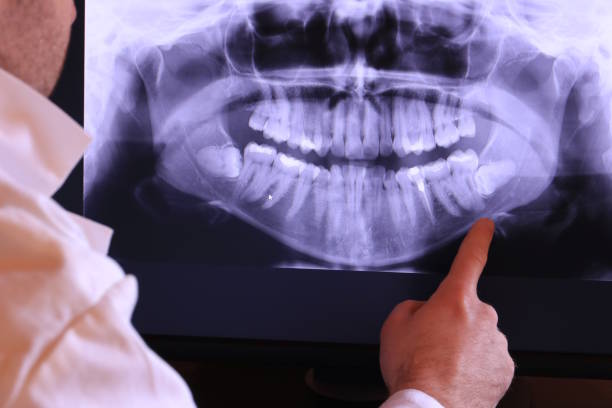 Best Emergency Wisdom Tooth Extraction in Clayton, AL